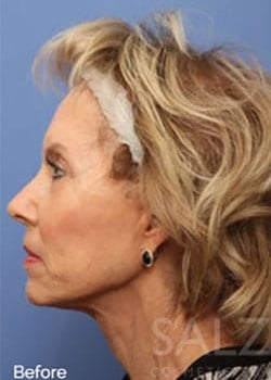 Before Image: Profractional - other