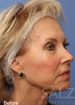 Before Image: Profractional - right-front-oblique