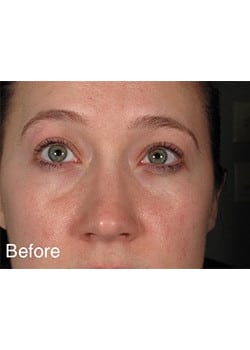 Before Image: Wrinkle Filler - front