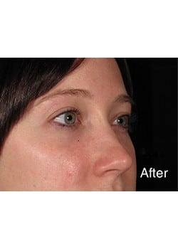 After Image: Wrinkle Filler - right-front-oblique