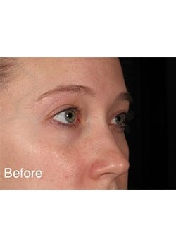 Before Image: Wrinkle Filler - right-front-oblique