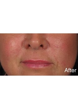 After Image: Wrinkle Filler - right-front-oblique