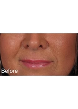 Before Image: Wrinkle Filler - right-front-oblique