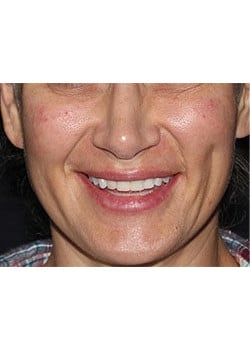 After Image: Wrinkle Filler - other