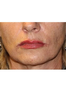 After Image: Wrinkle Filler