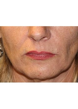 Before Image: Wrinkle Filler