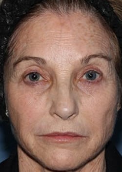 Before Image: Wrinkle Filler