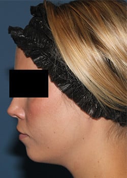 After Image: Kybella - other