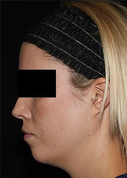 Before Image: Kybella - other