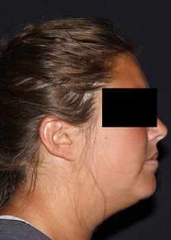Before Image: Kybella - other