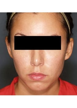 After Image: Ear Pinning - front