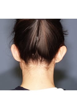 Before Image: Ear Pinning - back