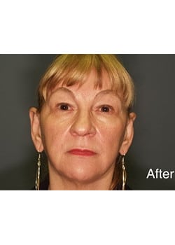 After Image: Ear Pinning