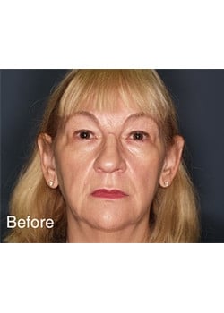 Before Image: Ear Pinning