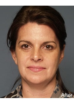 After Image: Ear Pinning - front