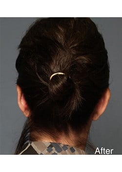 After Image: Ear Pinning - back