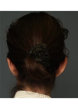 Before Image: Ear Pinning - back