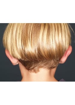 After Image: Ear Pinning