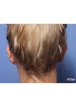 After Image: Ear Pinning