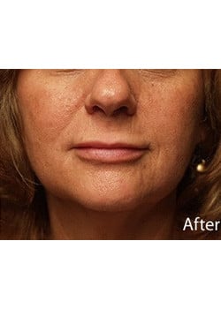 After Image: Lip Implant - other