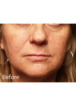 Before Image: Lip Implant - other