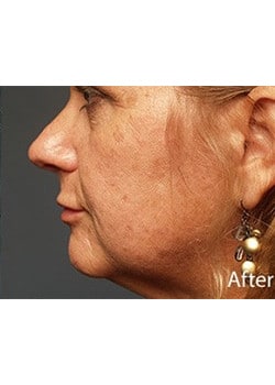 After Image: Lip Implant - other