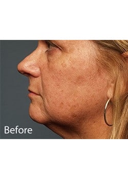 Before Image: Lip Implant - other