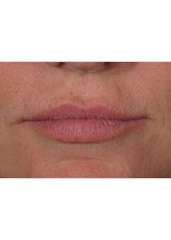 Before Image: Lip Enlargement - front
