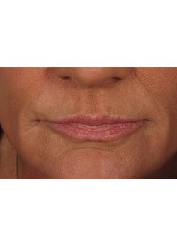 After Image: Lip Enlargement - front