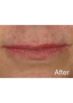 After Image: Lip Enlargement - front