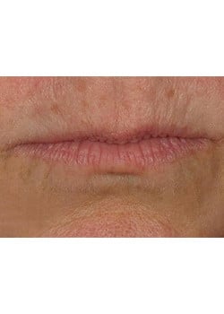 Before Image: Lip Enlargement - front