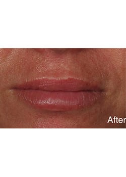 After Image: Lip Enlargement - front