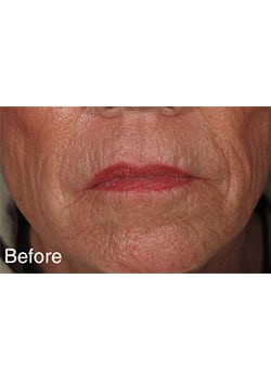 Before Image: Lip Enlargement - front