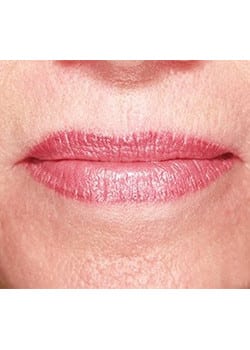 Lip Lift