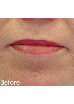 Lip Lift