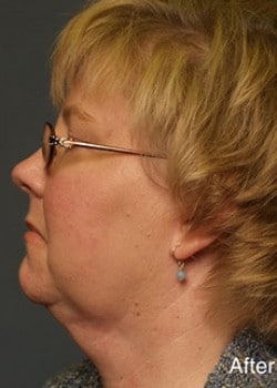 After Image: Liteshape Necklift - other