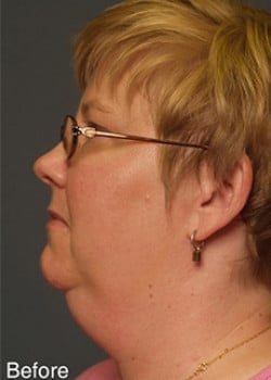 Before Image: Liteshape Necklift - other