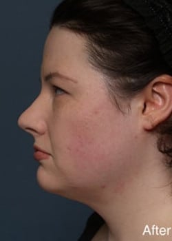 After Image: Liteshape Necklift - other