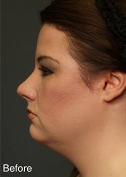 Before Image: Liteshape Necklift - other