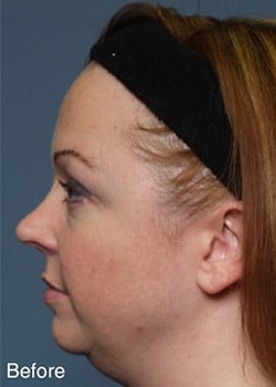 Before Image: Liteshape Necklift - other