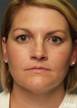 After Image: Liteshape Necklift - front