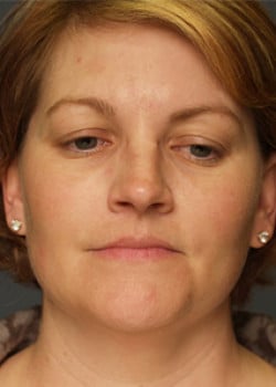 Before Image: Liteshape Necklift - front