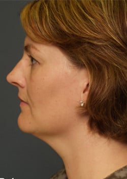 Before Image: Liteshape Necklift - other