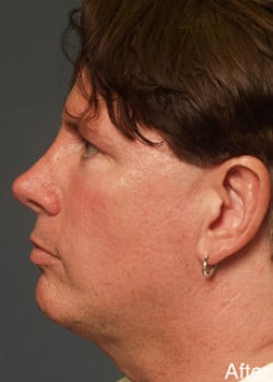 Liteshape Necklift