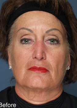 Before Image: Liteshape Necklift - front