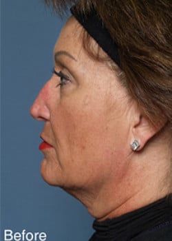 Liteshape Necklift