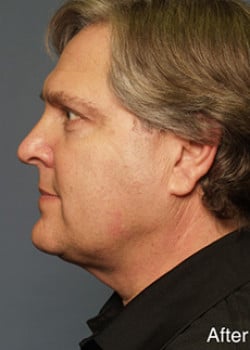 After Image: Liteshape Necklift - other