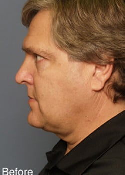 Before Image: Liteshape Necklift - other