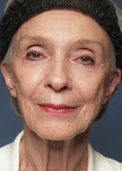 Before Image: Fusion Facelift Case 3 - front