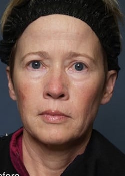Before Image: Fusion Facelift Case 1 - front